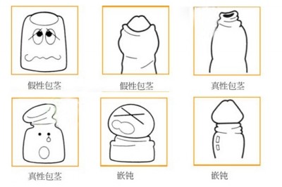 男性包皮过长是什么因素引起的?